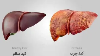 با این سه مورد کبد چرب تان را درمان کنید