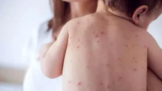 زنگ خطر شیوع مجدد سرخک به صدا درآمد