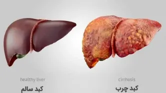 کاهش خطر کبد چرب با لوبیا و سویا/ چگونه این پروتئین‌های گیاهی کمک می‌کنند؟