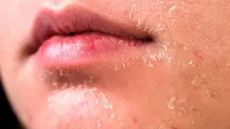 کمبود این ویتامین‌ها و خشکی پوست صورت