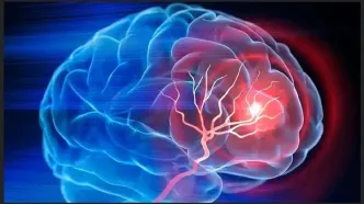 میگرن شایع ترین نوع سردرد/ شیوع آلزایمر در کشور رو به افزایش است
