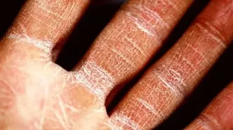 تغییرات اقلیمی، دشمن اگزما؛ آلودگی هوا و دماهای شدید بیماری پوستی را تشدید می‌کنند