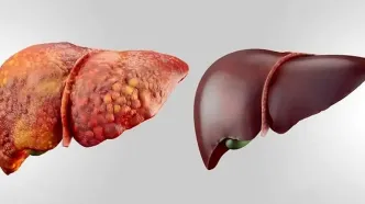 پنج علامت مهم ابتلا به کبد چرب