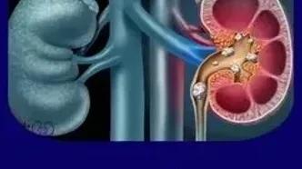 چه کار کنیم که دچار ابتلا به سنگ کلیه نشویم؟