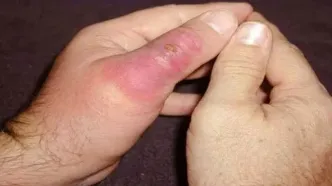 هشدار جدی دانشگاه علوم پزشکی هرمزگان درباره افزایش موارد گزش در فصل گرما