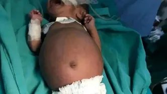 تولد نوزادی که در شکمش جنین دوقلوی خود را داشت!