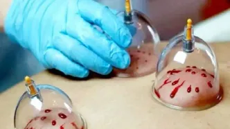 از سردرد تا فشار خون/ معجزه حجامت زیر ذره‌بین