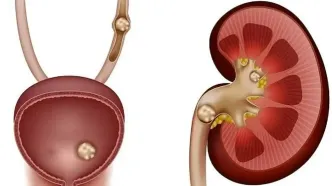 راهنمای جامع پیشگیری و درمان سنگ کلیه: از رژیم غذایی تا علائم هشداردهنده