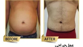 قیمت لیپوماتیک در سال 1404، مزایای آن را می‌دانید؟