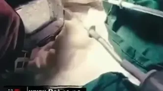 خارج کردن نیزه فلزی از دهان کودک ۱۱ ساله در ایرانشهر