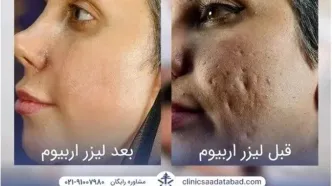 لیزر اربیوم؛ درمان فوری و قطعی جای جوش، حذف تتو و بخیه