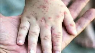 عوارض خطرناک آبله مرغان در بزرگسالی