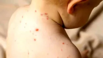 هشدار جدی درباره آمار فاجعه‌بار سرخک در ایران