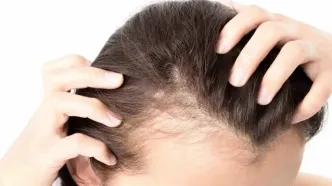این مواد غذایی باعث ریزش مو میشوند!