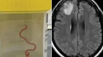 خارج کردن کرم ۱۸ سانتی‌متری از مغز یک مرد