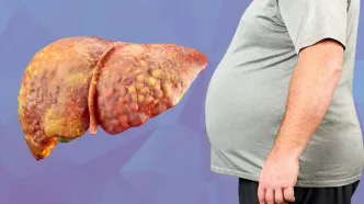 یک داروی ضد چاقی علیه کبد چرب