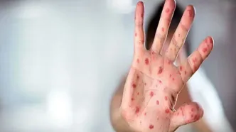 خطر نهضت ضد واکسن و بازگشت بیماری های واگیر