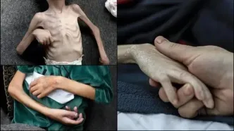 چه تعداد در غزه به دلیل سوء تغذیه به شهادت رسیدند؟