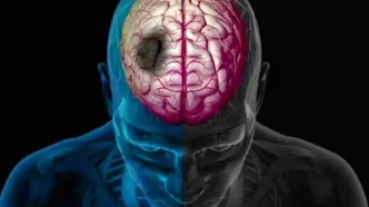 روزانه ۲۰۰ تهرانی دچار سکته مغزی می‌شوند!