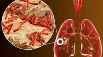ابتلای ۶ هزار ایرانی به یک بیماری خطرناک ریوی/ ۸ استان در صدر شیوع بیماری