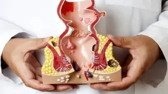 برای درمان بواسیر  چکار کنیم؟