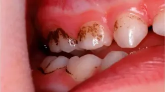 خوراکی‌های مفید برای سلامت دندان