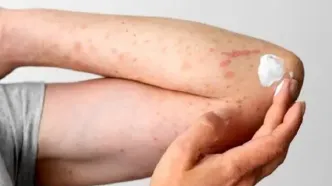 تشخیص اشتباه و مصرف پماد کورتونی، عامل گسترش قارچ پوستی