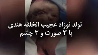 تولد نوزاد عجیب الخلقه هندی با 3 صورت و 3 چشم