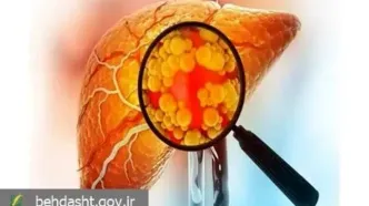 هشدار دفتر بهبود تغذیه جامعه وزارت بهداشت به درمان نادرست کبد چرب