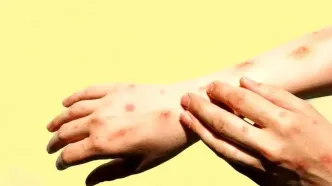 زنگ خطر شیوع تب دنگی در این منطقه به صدا در آمد