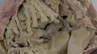ببینید؛ جنین مومیایی شده از بدن یک زن سالمند خارج شد