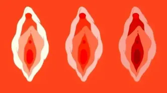 تورم لبهای کوچک واژن: از دلایل شایع تا درمانهای مؤثر