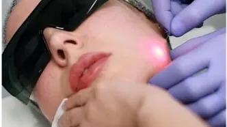 لیفت صورت با دستگاه اندولیفت یوفوتون