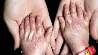 بیماری پروانه‌ای بیشتر در خانواده‌ های دارای ازدواج فامیلی بروز می‌کند