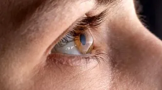 چرا چشم ایرانی‌ها بیشتر درگیر قوز قرنیه است؟