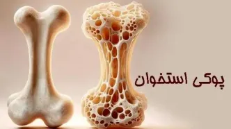 زنان بیش از مردان در معرض ابتلا به پوکی استخوان هستند