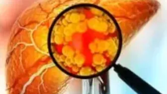 آیا میوه هم باعث کبد چرب می شود؟