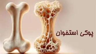 وقتی کودکان دچار پوکی  می‌شوند؛ واقعیتی که باید جدی گرفته شود