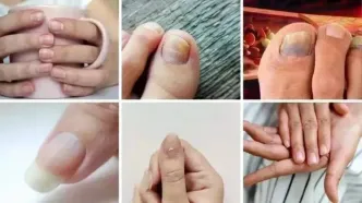 ۷ علامت هشداردهنده کلسترول بالا در ناخن کدامند؟