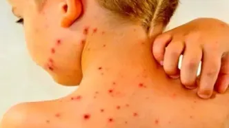 کاهش میزان واکسیناسیون آمار ابتلا به سرخک را افزایشی کرد