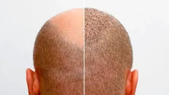 بهترین کلینیک‌های کاشت مو در کرج+ معرفی 10 کلینیک برتر