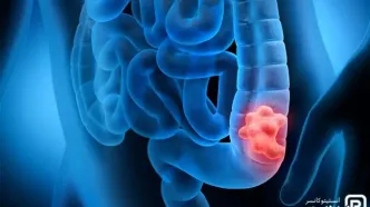 چطور جلوی سرطان روده را بگیریم؟