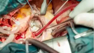 اعتراض پزشکان به حقوق کم؛ عمل جراحی قلب باز نزدیک ۲ میلیاردتومان است نه ۲۰۰میلیون!