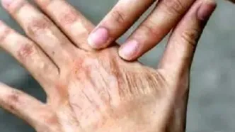 تاثیر خاموش آلودگی هوا بر سلامت و پیری پوست