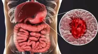 این داروها دومین علت شایع زخم معده هستند