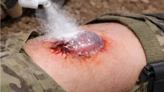 روش‌های اورژانسی پیشگیری از خونریزی در مجروحان