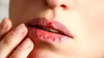 علت ترک در اطراف دهان و لب‌های پوسته پوسته چیست؟