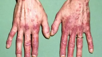 لوپوس در کودکان خطرناک‌تر و پیشرونده‌تر است