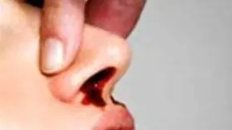 علت خونریزی بینی بیشتر کودکان نسبت به بزرگسالان چیست؟