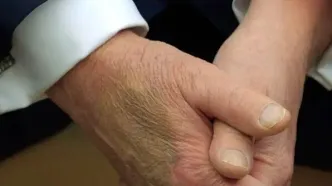 ترامپ استفاده از آسپرین را دلیل کبودی دست خود معرفی کرد